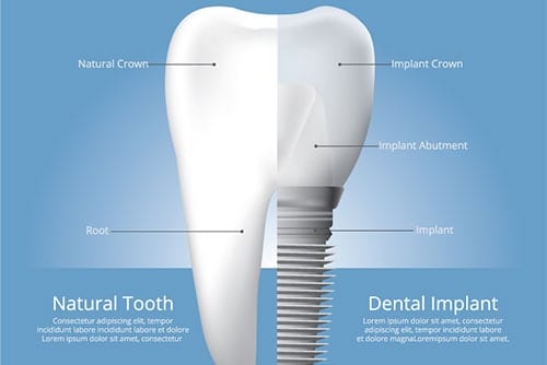 Dental Implants in Wyomissing, PA