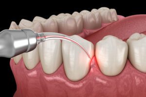 Laser Dentistry