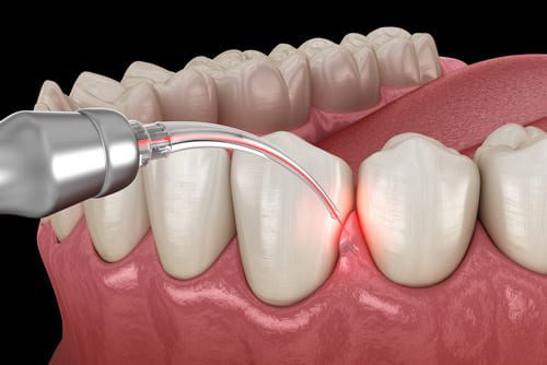 Laser Dentistry