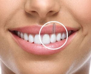 dental-implant-wyomissing