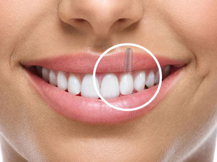 dental-implant-wyomissing